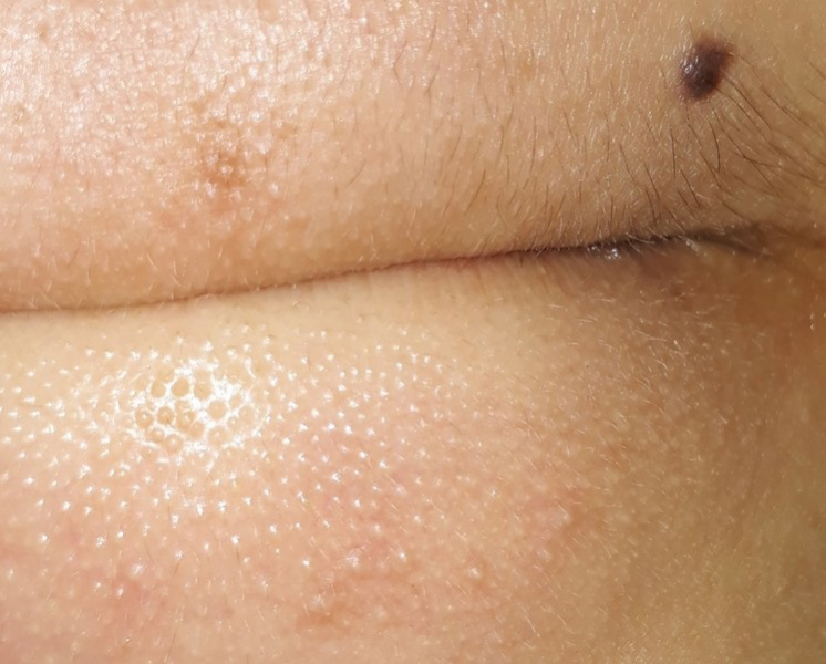  Trị Mụn Ẩn Và Mụn Cám Tại Sen Beauty